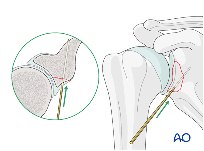 ORIF - Lag screw fixation for Glenoid fossa, partial articular ...