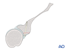 glenoid fossa partial articular anterior simple