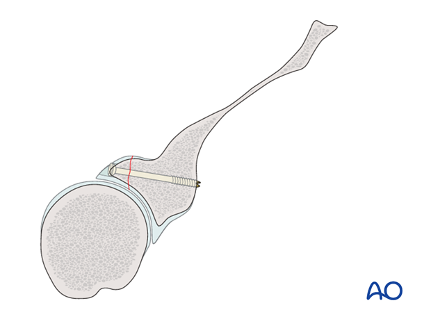 glenoid fossa partial articular posterior simple