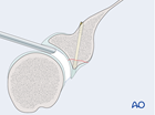 glenoid fossa partial articular anterior simple