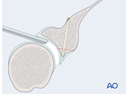 glenoid fossa partial articular transverse simple