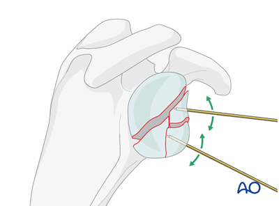 ORIF - Lag screw fixation for Glenoid fossa, partial articular ...