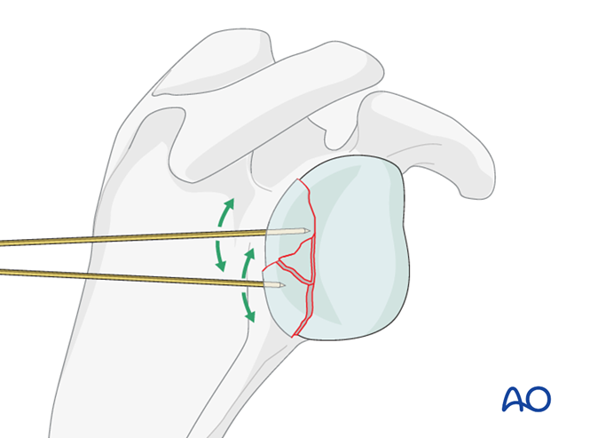 ORIF - Lag screw fixation for Glenoid fossa, partial articular ...