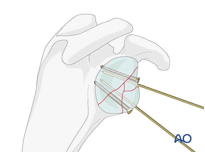 ORIF - Lag screw fixation for Glenoid fossa, partial articular ...