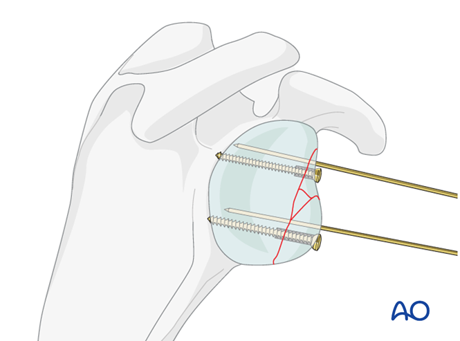 ORIF - Lag screw fixation for Glenoid fossa, partial articular ...