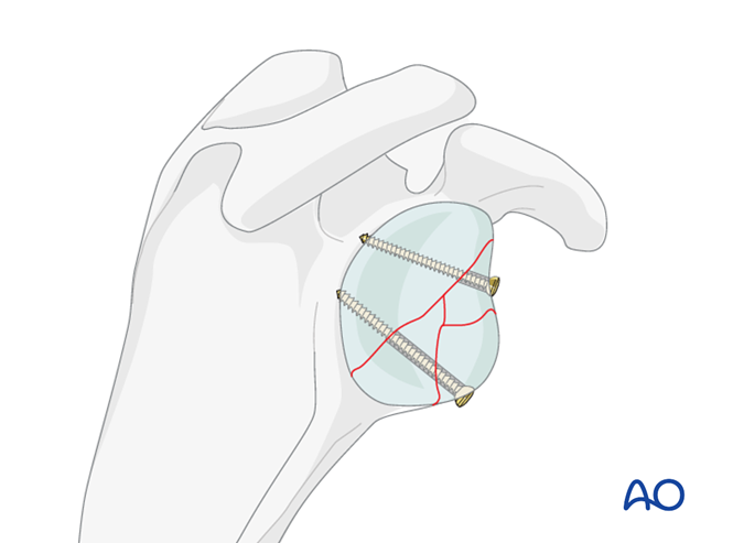 ORIF - Lag screw fixation for Glenoid fossa, partial articular ...