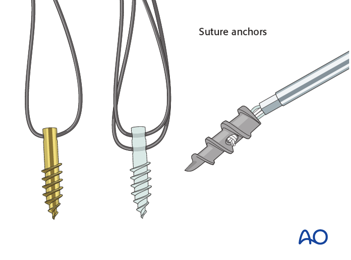 ORIF - Suture Anchors For Glenoid Fossa, Partial Articular, Anterior Simple