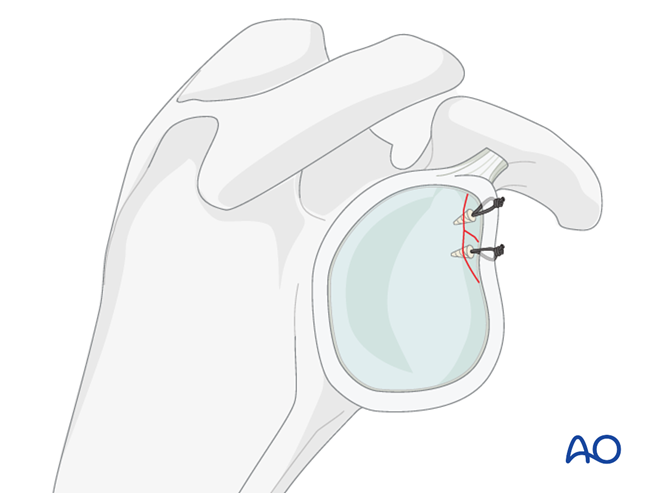 ORIF - Lag screw fixation for Glenoid fossa, partial articular ...