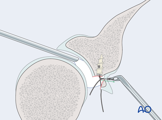 orif suture anchors