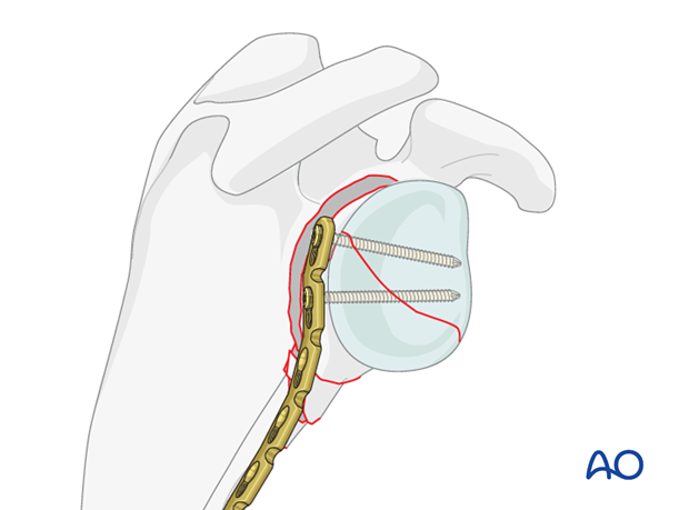 orif plate fixation