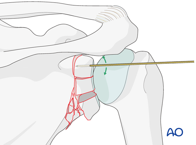 ORIF - Plate fixation for Glenoid fossa, complete articular, articular ...