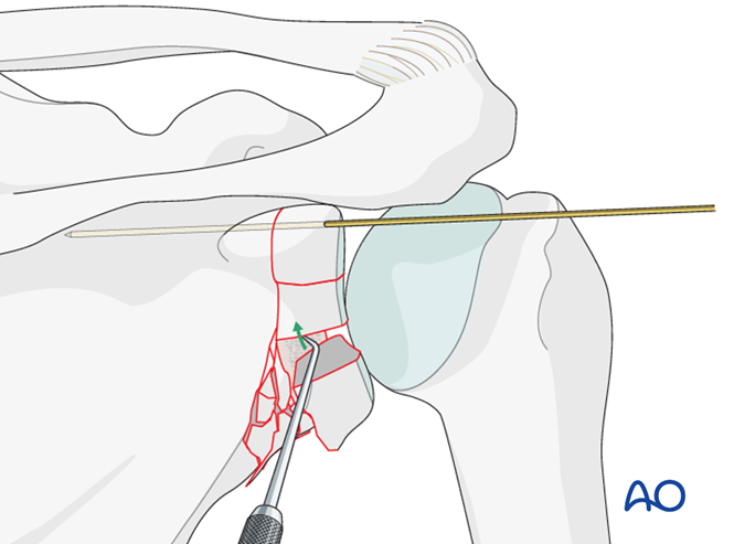 ORIF - Plate fixation for Glenoid fossa, complete articular, articular ...