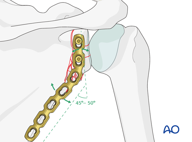 orif plate fixation