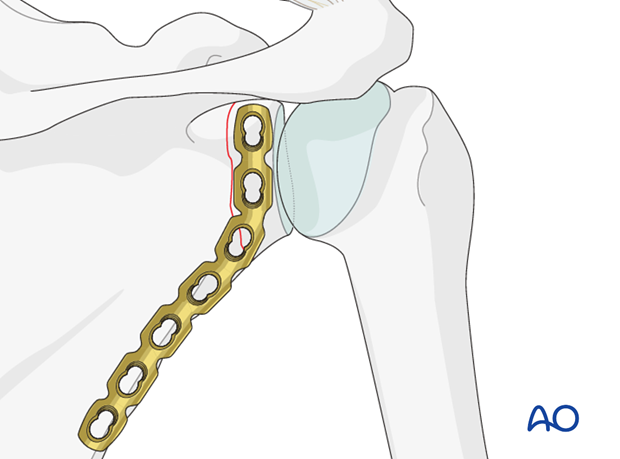 orif plate fixation