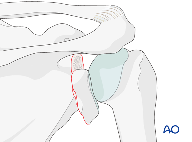 ORIF - Plate fixation for Glenoid fossa, extraarticular, simple