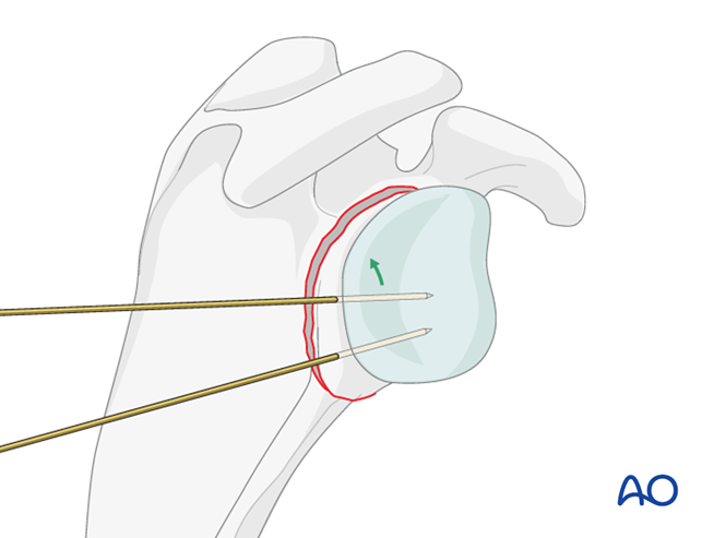 ORIF - Plate fixation for Glenoid fossa, extraarticular, simple