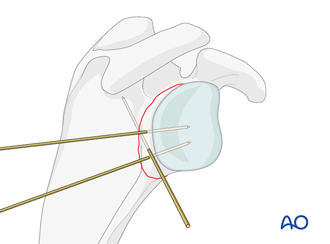 ORIF - Plate fixation for Glenoid fossa, extraarticular, simple