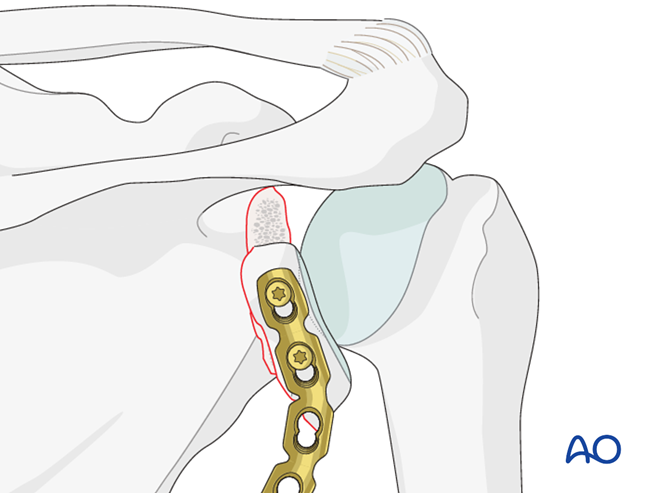 ORIF - Plate fixation for Glenoid fossa, extraarticular, simple