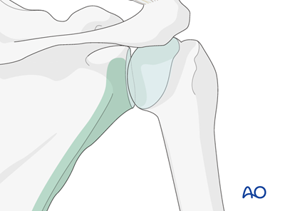 ORIF - Plate fixation for Glenoid fossa, extraarticular, simple