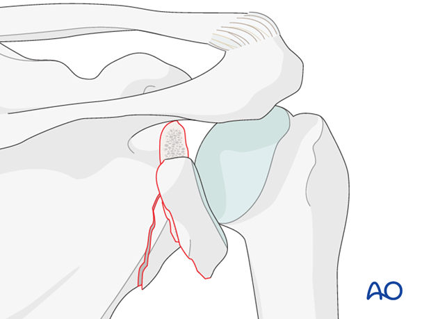 orif plate fixation