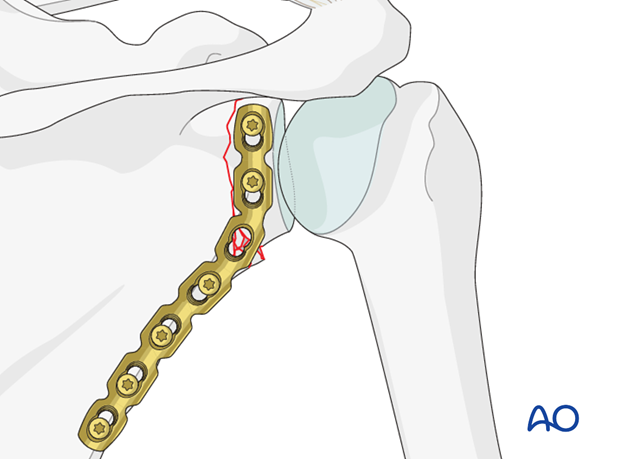 glenoid fossa extraarticular multifragmentary