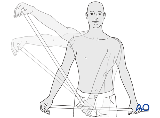 An exercise bar lets the patient use the uninjured left shoulder to passively move the affected right side.