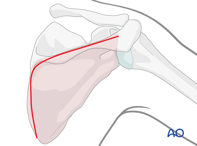 Orif - Lag Screw Fixation For Glenoid Fossa, Partial Articular 