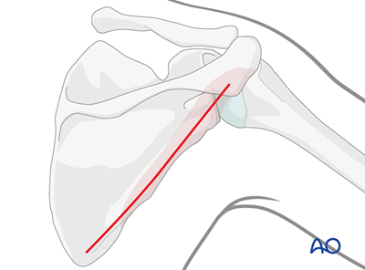 Posterior approach to the scapular body