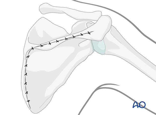 Wound closure