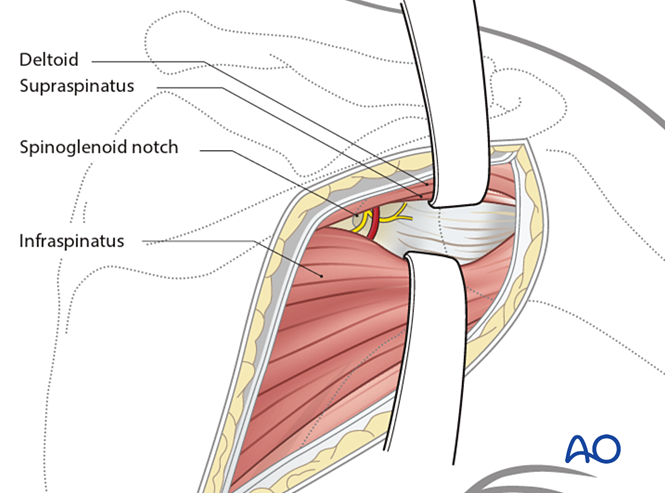 Posterior approach to the scapular body