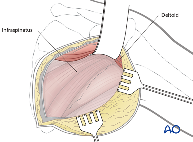 Modified Judet approach