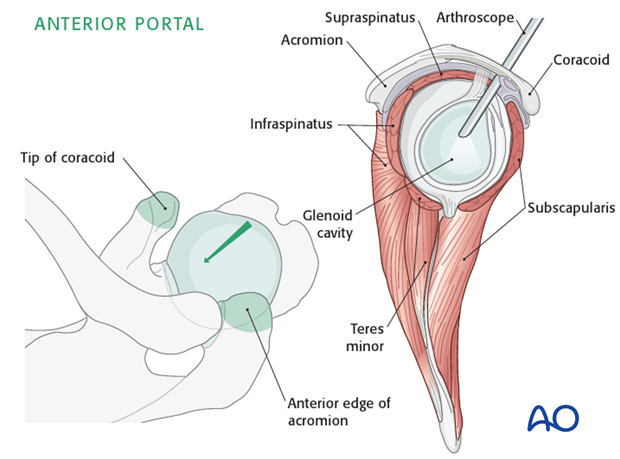 Anterior standard portal