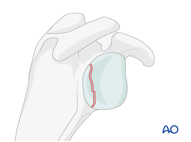 Glenoid fossa, partial articular, posterior simple