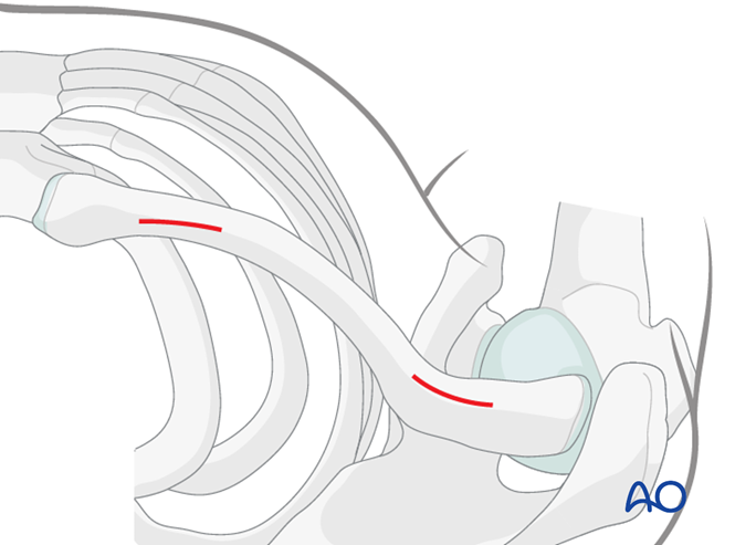 MIPO - anterior approach to the clavicle