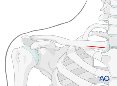 Flexible intramedullary nail for Diaphyseal simple, transverse clavicle ...