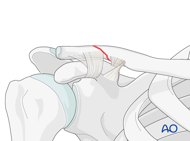 Lateral, undisplaced fracture with CC intact, extraarticular clavicle ...