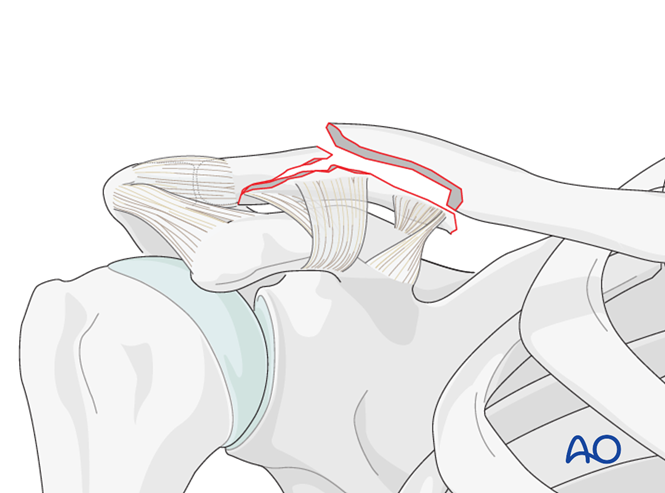 Lateral, displaced fracture with CC intact, fragmentary clavicle fracture