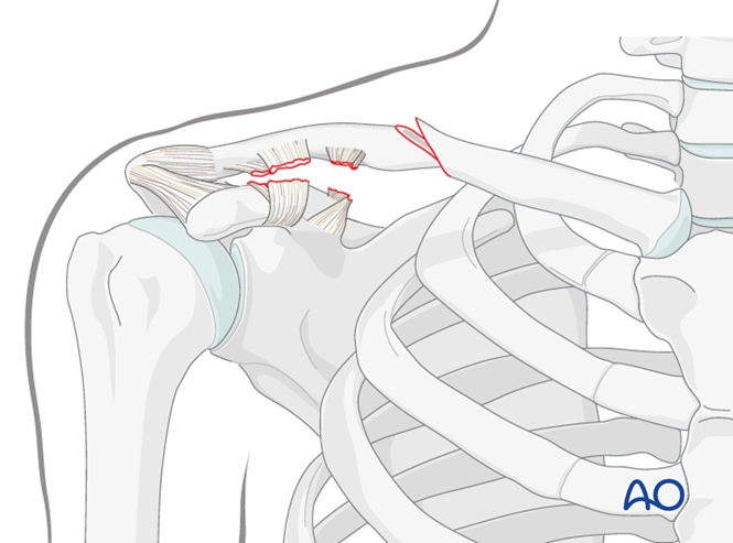 ORIF - Lag screw with neutralization plate for Diaphyseal simple ...