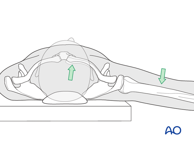 reduction of sternoclavicular dislocation