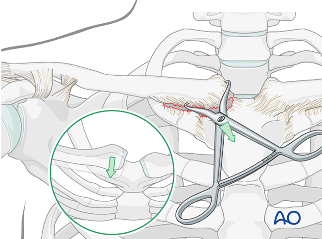 Reduction of sternoclavicular dislocation for Medial, articular ...