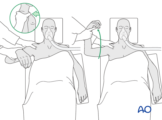 Flexible Intramedullary Nail For Diaphyseal Simple, Transverse Clavicle 