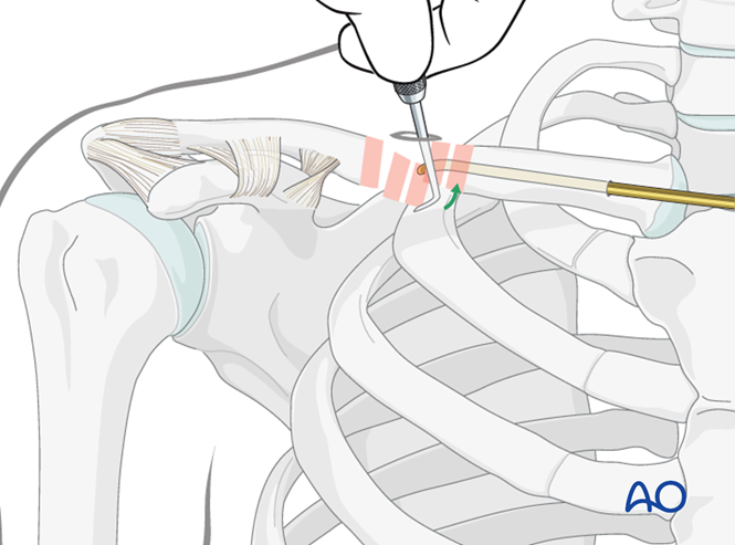 Flexible intramedullary nail for Diaphyseal simple, transverse clavicle ...