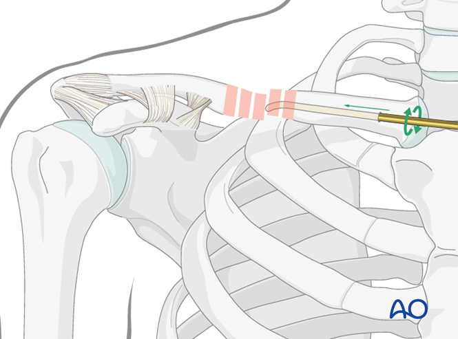 Flexible intramedullary nail for Diaphyseal simple, transverse clavicle ...