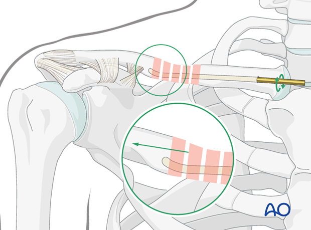 flexible intramedullary nail