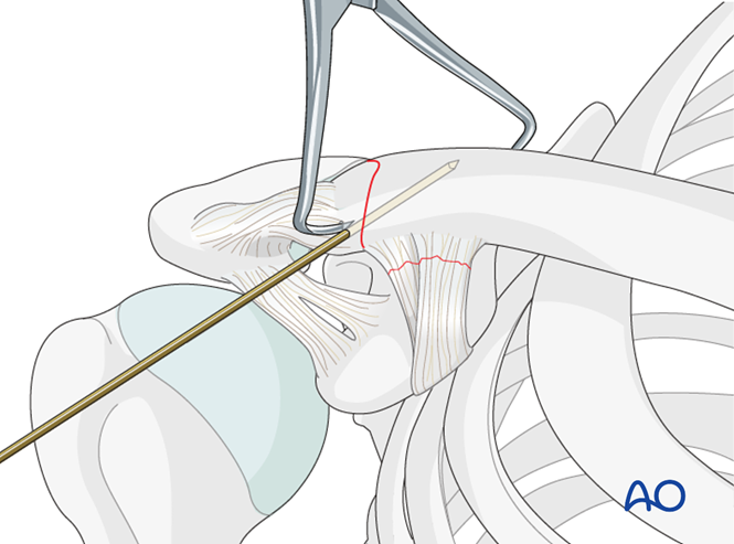 ORIF - Hook plate for Lateral, displaced fracture with CC disrupted ...