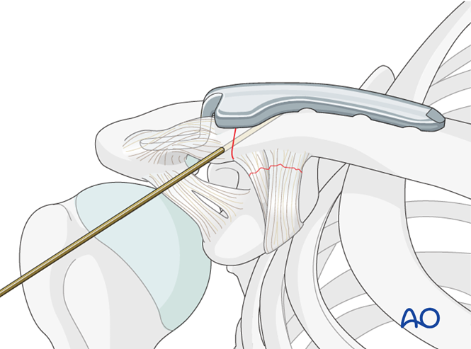 ORIF - Hook plate for Lateral, displaced fracture with CC disrupted ...