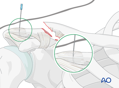 ORIF - Pre-contoured distal plate for Lateral, displaced fracture with ...