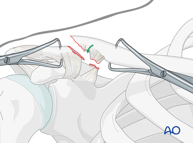 ORIF - Pre-contoured distal plate for Lateral, displaced fracture with ...