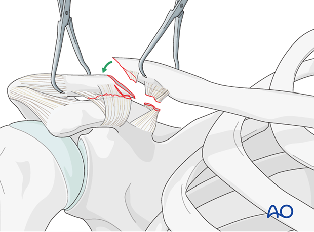 orif pre contoured distal plate