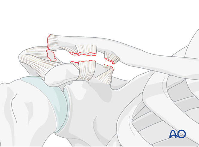 Ligament reconstruction